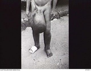 GOODENOUGH ISLAND, 1944-04-21. AT THE AUSTRALIAN NEW GUINEA ADMINISTRATIVE UNIT NATIVE HOSPITAL AT GOODENOUGH ISLAND, AN EXAMPLE OF A NATIVE SUFFERING FROM ELEPHANTIASIS