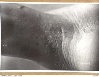 GRAFTON, NSW. 1943-04. BLISTERS SUSTAINED BY ARMY PERSONNEL TAKING PART IN CHEMICAL WARFARE EXPERIMENTS NEAR LAKE HIAWATHA. THE PERSONNEL WERE ACTING AS HUMAN "GUINEA PIGS" AND ENTERED AN AREA THAT ..