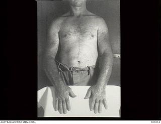 Lae, New Guinea. 1945-05-04. Medical record photograph made at the request of Major R. Perkings, Dermatologist, 2/7th Australian General Hospital showing a patient suffering from Infectious ..