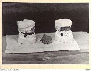 TOROKINA, BOUGAINVILLE, 1945-06-21. CORRECTION OF MALOCCLUSION FOR PATIENT, SGT W.T. O'CONNOR, AT HQ 4 BASE SUB AREA, BY DENTAL OFFICER, MAJ A.G. ROWELL. MODELS AND DENTURE, RIGHT LATERAL VIEW. ..