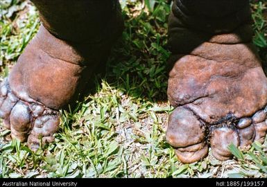 Filariasis feet, New Hebrides