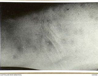 FORBES, AUSTRALIA. 1943-02. ANTERIOR SURFACE OF ELBOW OF A HUMAN "GUINEA PIG" ON THE MORNING AFTER IT HAD BEEN EXPOSED TO THE EFFECTS OF GAS FROM GAS SHELLS FIRED IN AN EXPERIMENTAL SHOOT