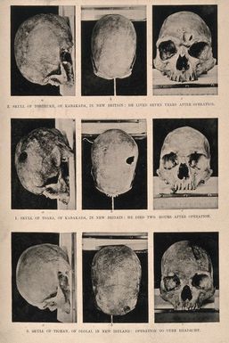 ["Three trephinated skulls of people who may have suffered from headaches or epilepsy, Papua New Guinea. Halftone."]