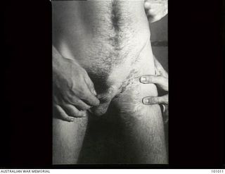 Lae, New Guinea. 1945-05-04. Medical record photograph made at the request of Major R. Perkings, Dermatologist, 2/7th Australian General Hospital showing a patient suffering from Lymphangioma ..