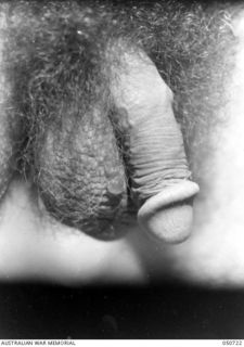 GRAFTON, NSW. 1943-04. BLISTERS SUSTAINED BY ARMY PERSONNEL TAKING PART IN CHEMICAL WARFARE EXPERIMENTS NEAR LAKE HIAWATHA. THE PERSONNEL WERE ACTING AS HUMAN "GUINEA PIGS" AND ENTERED AN AREA THAT ..