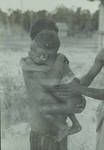 Iuri boy with Yaws at hospital, Green River, [Papua New Guinea], 1954