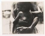 Child with yaws (framboesia), Gusap, New Guinea, 1945