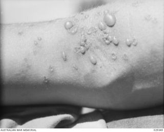 FORBES, AUSTRALIA. 1943-02. ANTERIOR SURFACE OF ELBOW OF A HUMAN "GUINEA PIG" IN THE EVENING OF THE SECOND DAY AFTER IT HAD BEEN EXPOSED TO THE EFFECTS OF GAS FROM GAS SHELLS FIRED IN AN ..