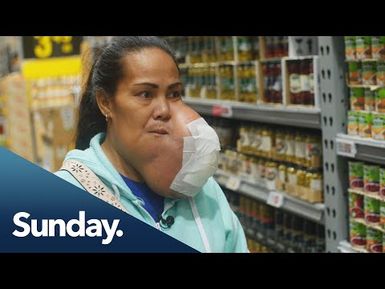 Tongan mum of nine gets life-saving surgery removing facial tumour in NZ