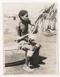 Man with yaws (framboesia), Dumpu, New Guinea, 1945