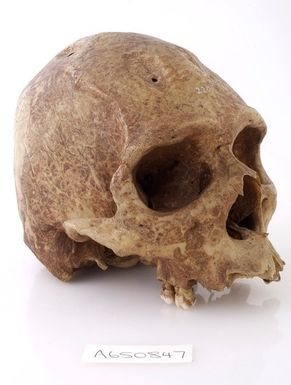 ["A human skull showing signs of Trepanning."]