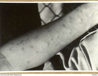 FORBES, AUSTRALIA. 1943-02. LEFT FOREARM OF A "GUINEA PIG" THE MORNING AFTER HE WAS EXPOSED TO THE EFFECTS OF GAS WHILE TAKING PART IN AN EXPERIMENTAL SHOOT OF GAS SHELLS
