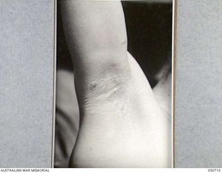 GRAFTON, NSW. 1943-04. BLISTERS SUSTAINED BY ARMY PERSONNEL TAKING PART IN CHEMICAL WARFARE EXPERIMENTS NEAR LAKE HIAWATHA. THE PERSONNEL WERE ACTING AS HUMAN "GUINEA PIGS" AND ENTERED AN AREA THAT ..