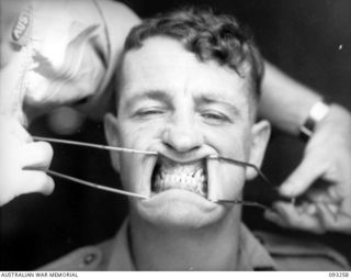 TOROKINA, BOUGAINVILLE, 1945-06-21. TREATMENT OF MALOCCLUSION AT HQ 4 BASE SUB AREA, FOR PATIENT SGT A.S. RINGWOOD, BY DENTAL OFFICER, MAJ A.G. ROWELL. ANTERIOR VIEW OF OLD PU AND PL DENTURES IN ..