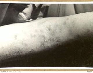 FORBES, AUSTRALIA. 1943-02. ANTERIOR SURFACE OF ELBOW OF A HUMAN "GUINEA PIG" IN THE EVENING OF THE DAY AFTER IT HAD BEEN EXPOSED TO THE EFFECTS OF GAS FROM GAS SHELLS FIRED IN AN EXPERIMENTAL ..