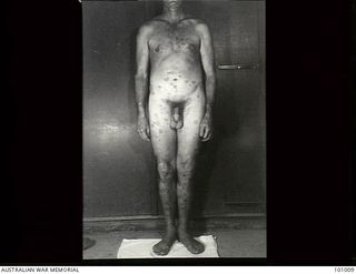 Lae, New Guinea. 1945-05-04. Medical record photograph made at the request of Major R. Perkins, Dermatologist, 2/7th Australian General Hospital showing a patient suffering from Tinea Circinate