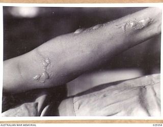 FORBES, AUSTRALIA. 1943-02. LEFT FOREARM OF A "GUINEA PIG" TAKING PART IN AN EXPERIMENTAL GAS SHELL SHOOT, WHO INDULGED IN UNAUTHORISED EXPERIMENTATION OF HIS OWN