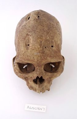 ["A human skull showing signs of Trepanning."]