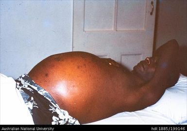 Swollen abdomen, liver failure - Ascites, Robert