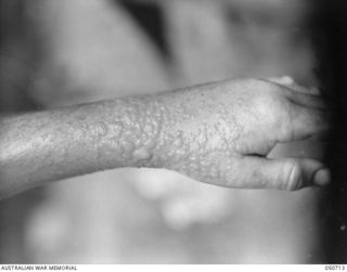 GRAFTON, NSW. 1943-04. BLISTERS SUSTAINED BY ARMY PERSONNEL TAKING PART IN CHEMICAL WARFARE EXPERIMENTS NEAR LAKE HIAWATHA. THE PERSONNEL WERE ACTING AS HUMAN "GUINEA PIGS" AND ENTERED AN AREA THAT ..