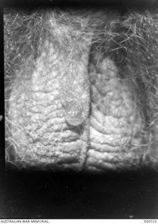 GRAFTON, NSW. 1943-04. BLISTERS SUSTAINED BY ARMY PERSONNEL TAKING PART IN CHEMICAL WARFARE EXPERIMENTS NEAR LAKE HIAWATHA. THE PERSONNEL WERE ACTING AS HUMAN "GUINEA PIGS" AND ENTERED AN AREA THAT ..