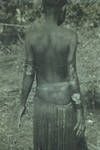 Huge tropical ulcers, Iuri woman, Green River Patrol, [Papua New Guinea], 1954