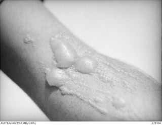 FORBES, AUSTRALIA. 1943-02. LEFT FOREARM OF A "GUINEA PIG" TAKING PART IN AN EXPERIMENTAL GAS SHELL SHOOT, WHO INDULGED IN UNAUTHORISED EXPERIMENTATION OF HIS OWN. THIS IS THE SAME ARM AS SHOWN IN ..